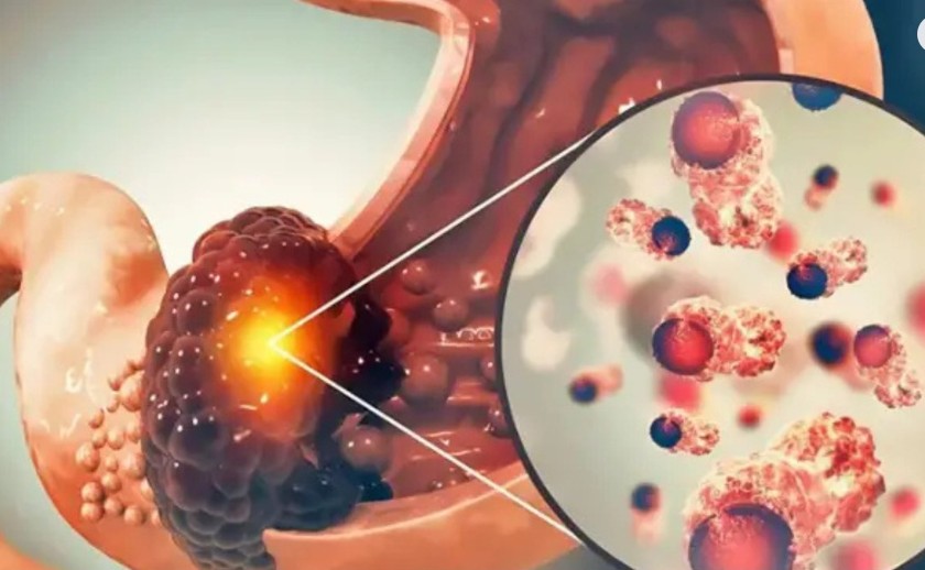 পেটের ক্যা’ন্সারের ৫টি ভয়ংকর ধরণ, যা দ্রুত ছড়িয়ে পড়ে